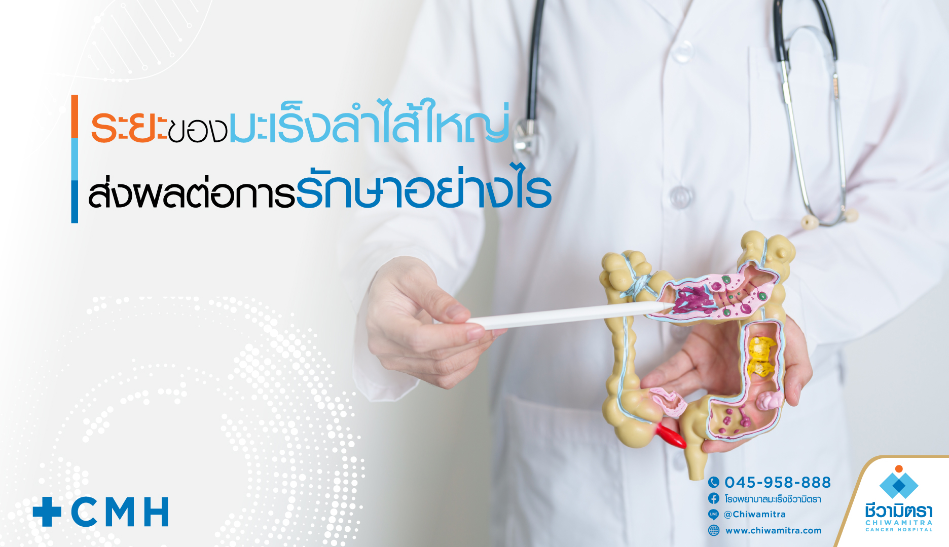 ระยะของมะเร็งลำไส้ใหญ่ ส่งผลต่อการรักษาอย่างไร